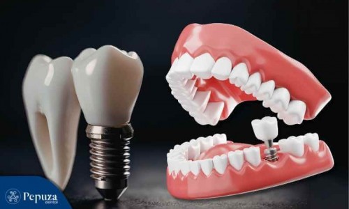 Atakum Mini Diş İmplantları