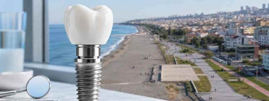 Samsun’da Diş İmplantları Samsun’da Diş İmplantları