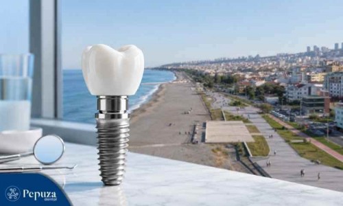Samsun’da Diş İmplantları