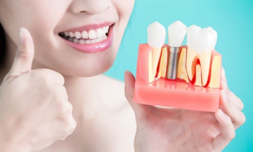 Implant Tedavisi Implant Tedavisi