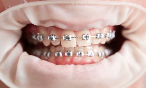 Samsun-Atakum Ortodonti Tedavisi