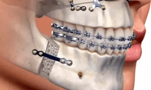 Çene Eklem Hastalıkları Belirtileri Nelerdir? Tedavi Yöntemleri Çene Eklem Hastalıkları Belirtileri Nelerdir? Tedavi Yöntemleri