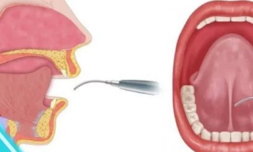 Frenektomi (Dudak/Dil Bağı Alınması) Nedir? Kimler İçin Gerekli?
