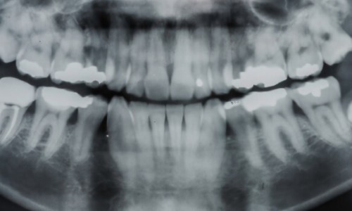 Samsun - Atakum Gömük Dişler Nasıl Çekilir? Ağrılı mı?