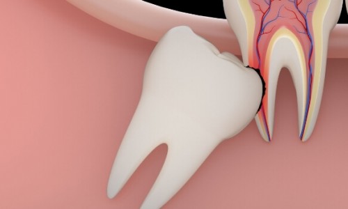 Gömük Dişler Ne Zaman Çekilmeli?