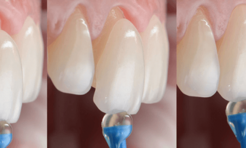 Samsun - Atakum Porselen Lamina Kaplama Hangi Durumlarda Tercih Edilmeli?