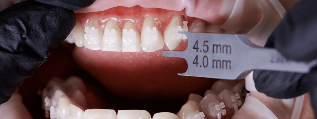 Diş Kaplaması Nedir ve Hangi Durumlarda Gereklidir?