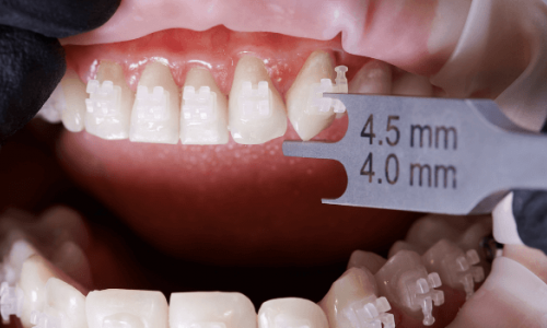 Diş Kaplaması Nedir ve Hangi Durumlarda Gereklidir?