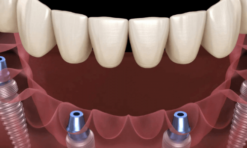 İmplant Tedavisi Acı Verir mi? İyileşme Süreci Ne Kadar Sürer?