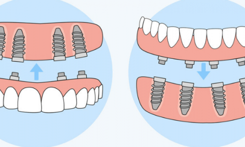 Samsun - Atakum All On Four İmplant Nedir? Kimler İçin Uygundur?