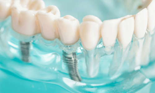 Tam Diş Protezleri mi İmplant mı? Hangisi Sizin İçin Uygun?