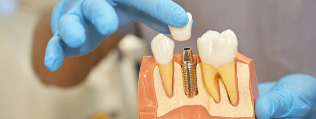 Samsun-Atakum Implant Tedavisinin Önemi