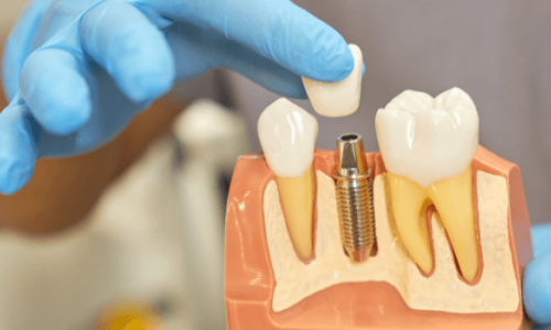 Diş Çekimi Gerektiren Durumlar Nelerdir?