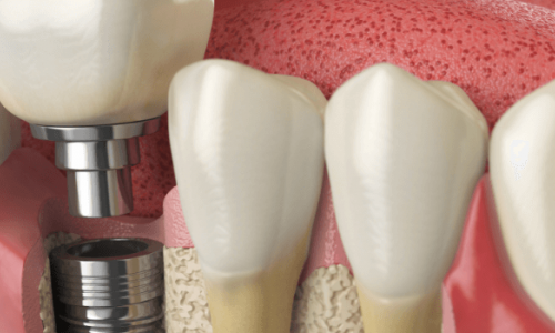 Diş İmplantı Sonrası Bakım Nasıl Olmalı?