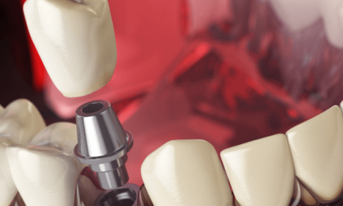 Mini Dental İmplantlar Kalıcı mıdır? Avantajları Nelerdir?