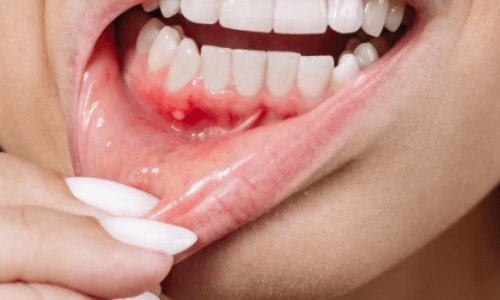 Diş Eti Kanaması Hangi Durumlarda Ciddiye Alınmalı?