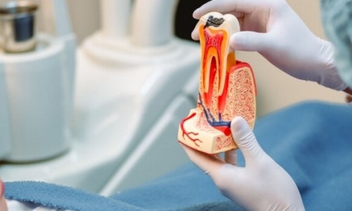 Kök Kanal Tedavisi Sonrası Dikkat Edilmesi Gerekenler Nelerdir?