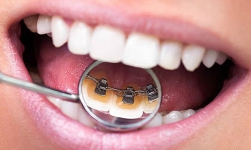 Lingual Ortodonti ile Diş Teli Arasındaki Farklar Nelerdir?
