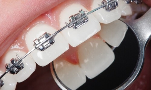 Ortodontik Tedavi Ne Kadar Sürer ve Hangi Yaşta Başlanmalı? Ortodontik Tedavi Ne Kadar Sürer ve Hangi Yaşta Başlanmalı?