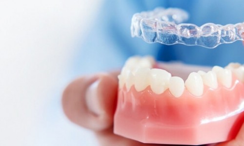 Telsiz Ortodontik Tedavi (Invisalign) ile Geleneksel Teller Arasındaki Farklar Nelerdir?