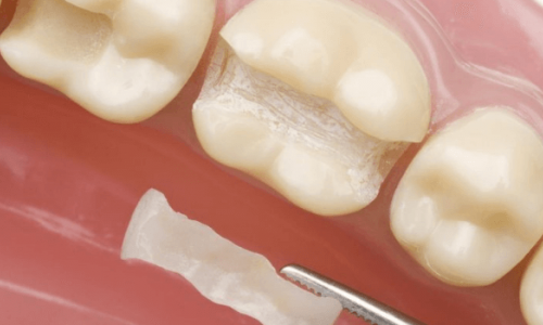 Diş Çürüğü İlerlemişse Ne Yapılmalı?